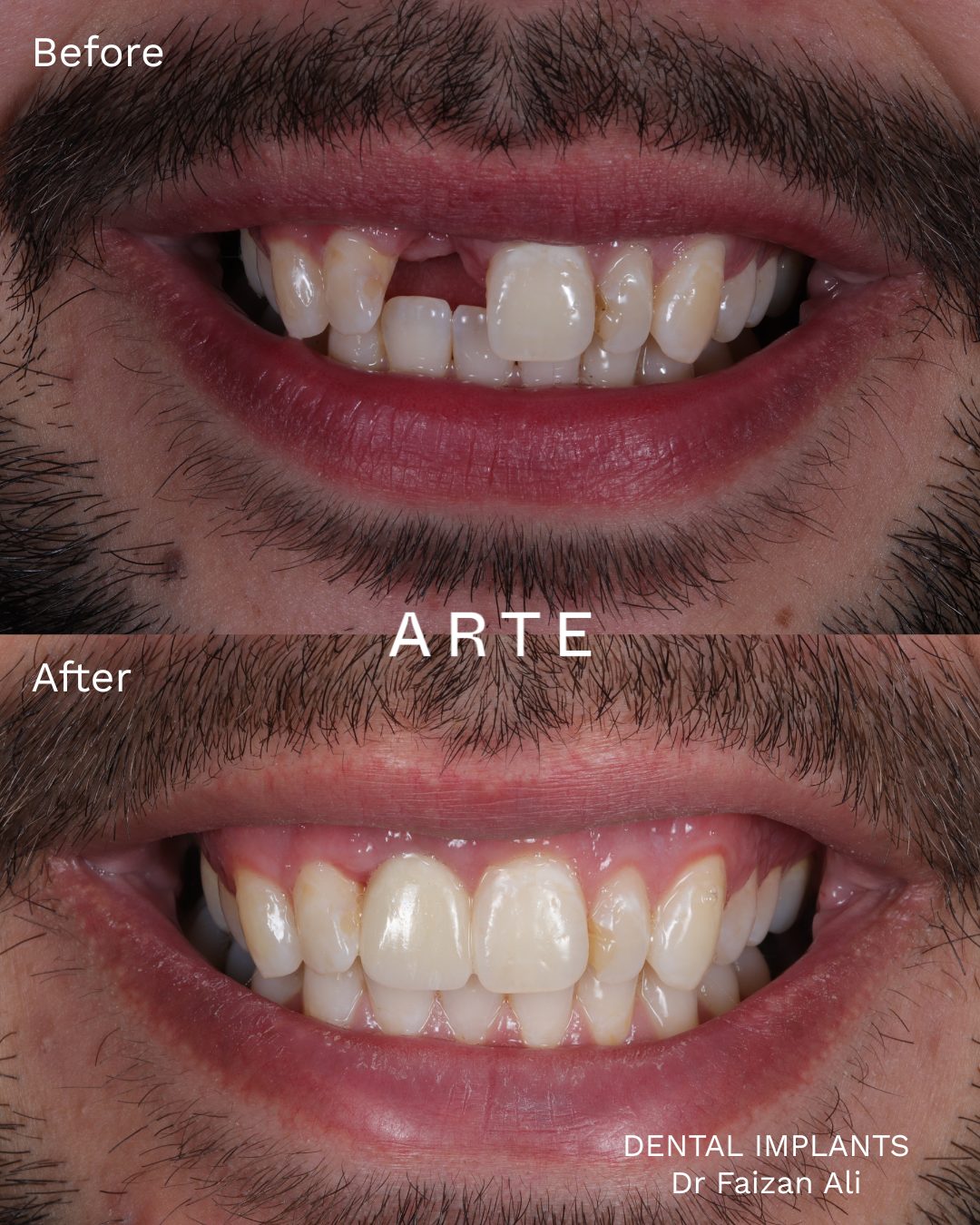 Smile transformation before and after