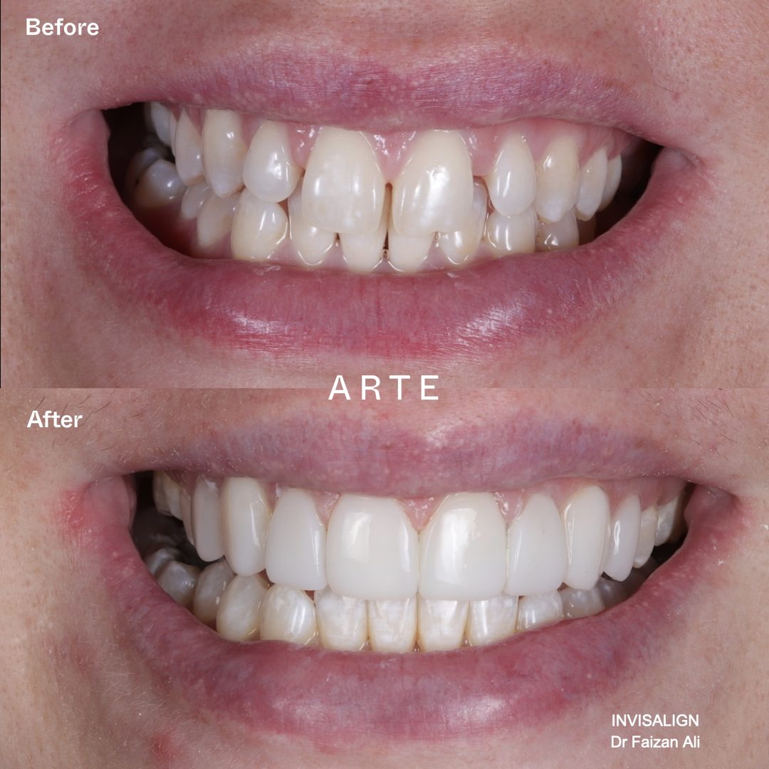 Smile transformation before and after